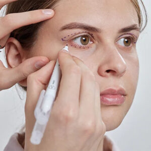 Blepharoplasty In Dubai