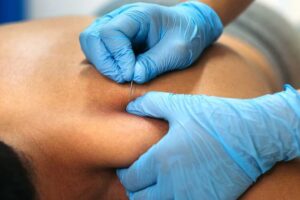 Dry Needling Nyc
