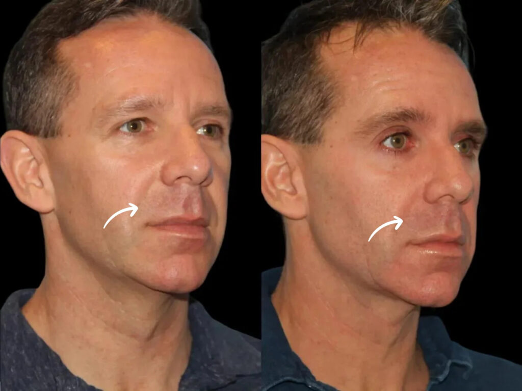 sculptra fillers in dubai