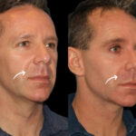 sculptra fillers in dubai
