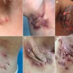 Hidradenitis Suppurativa Supplements