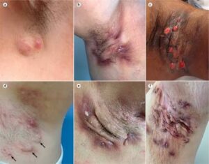 Hidradenitis Suppurativa Supplements