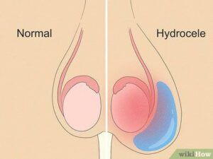 Hydrocele Supplements for Men