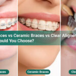 Metal-Braces-vs-Ceramic-Braces-vs-Clear-Aligners-Which-Should-You-Choose