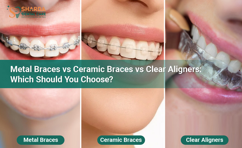 Metal-Braces-vs-Ceramic-Braces-vs-Clear-Aligners-Which-Should-You-Choose