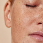 Pigmentation in Dubai