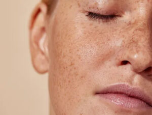 Pigmentation in Dubai