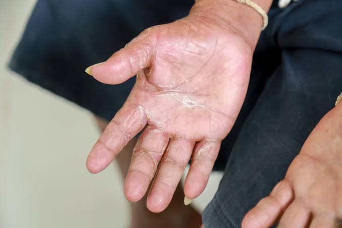 Can Natural Remedies Help with Scleroderma? Benefits, Risks, and Facts