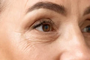 Fine Lines and wrinkles